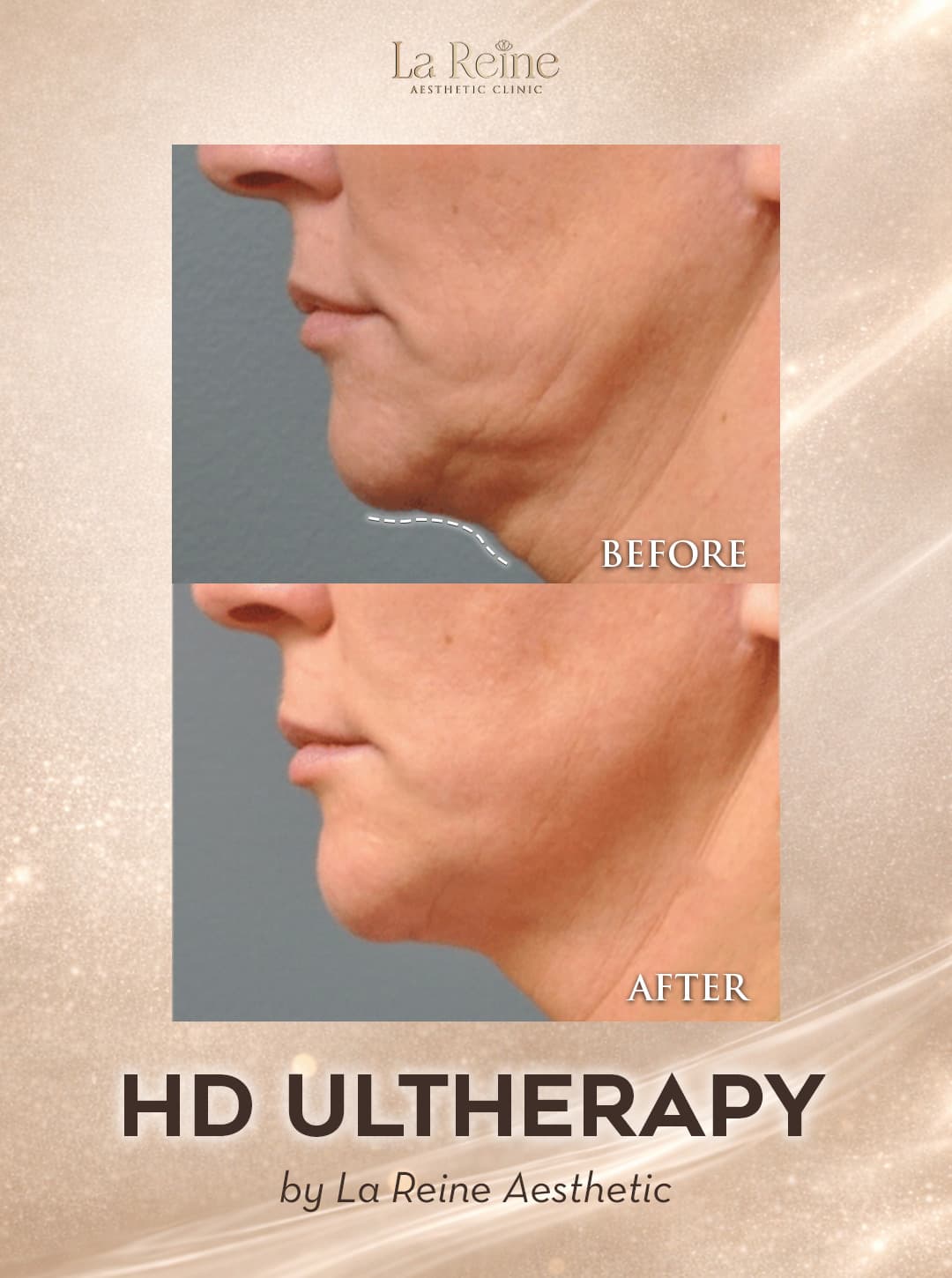 HD Ultherapy Before After Case 2