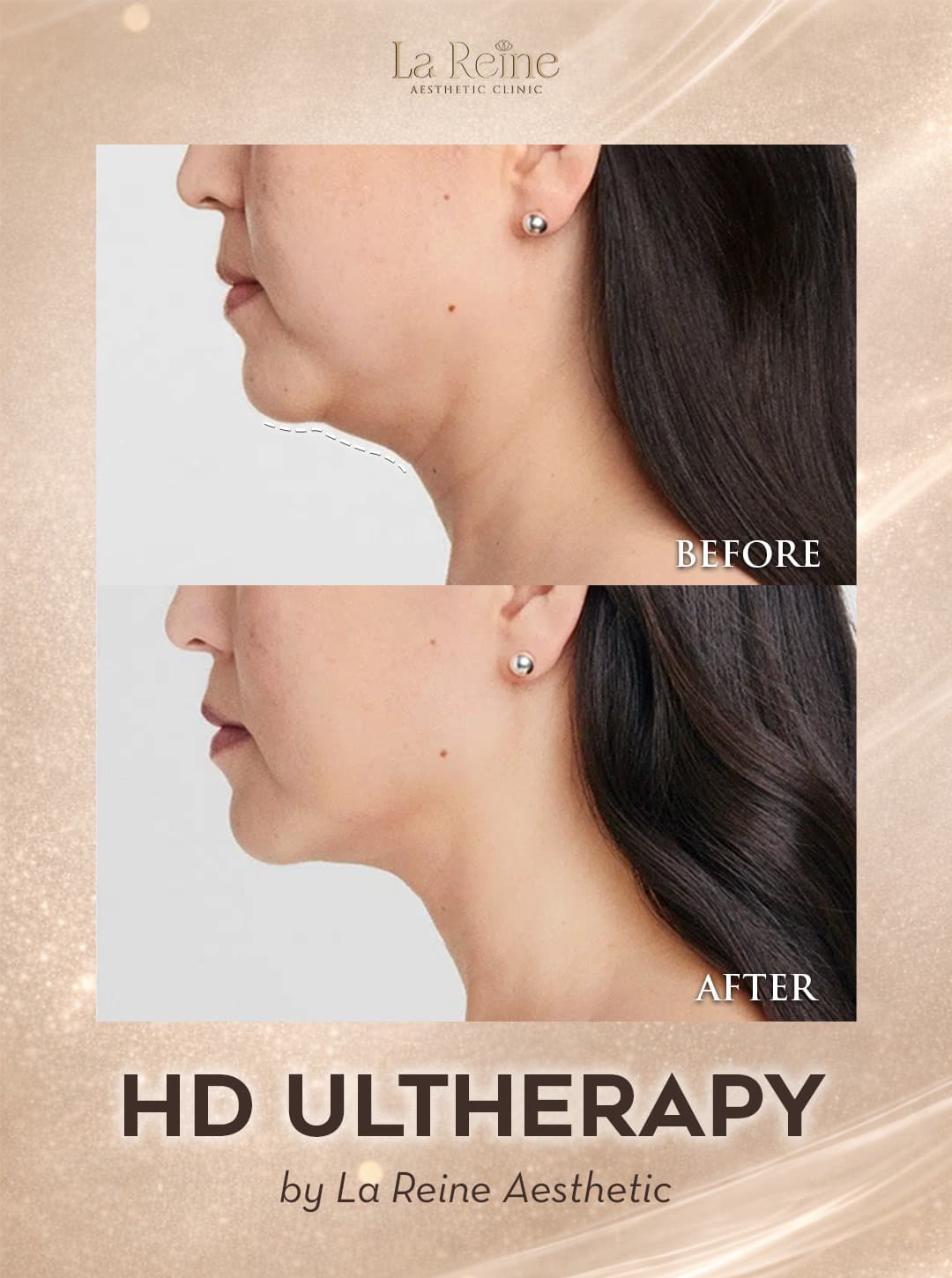 HD Ultherapy Before After Case 3