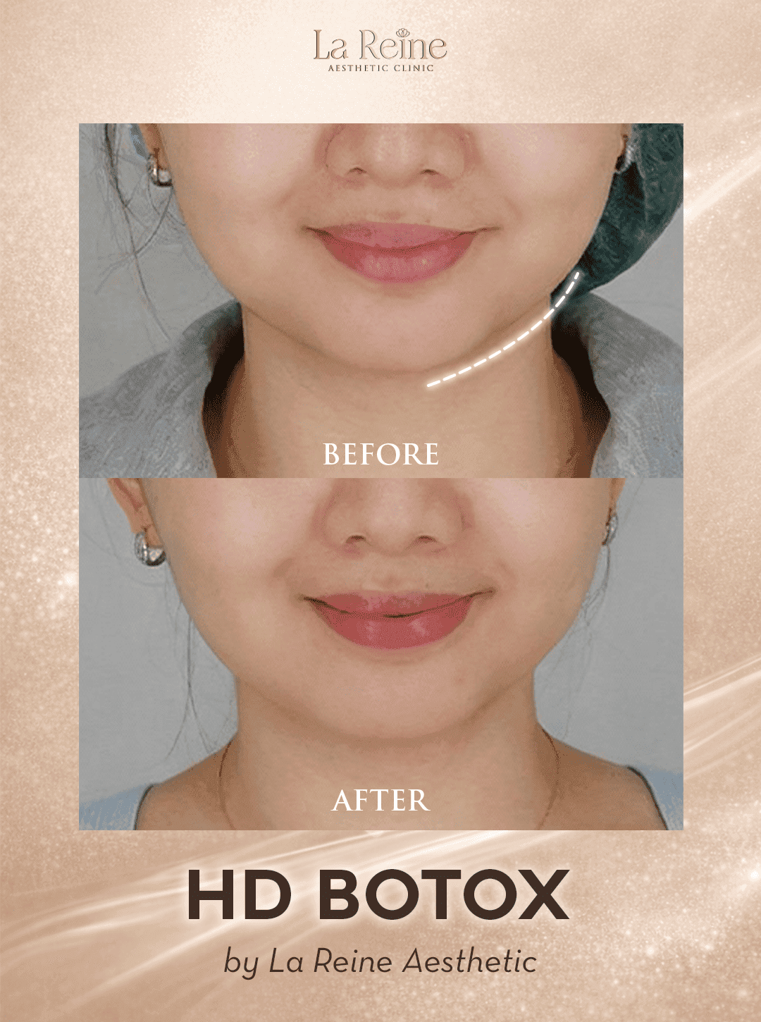 HD Botox Before After Case 1