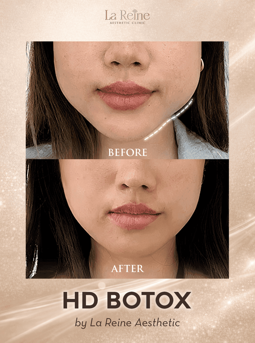 HD Botox Before After Case 2