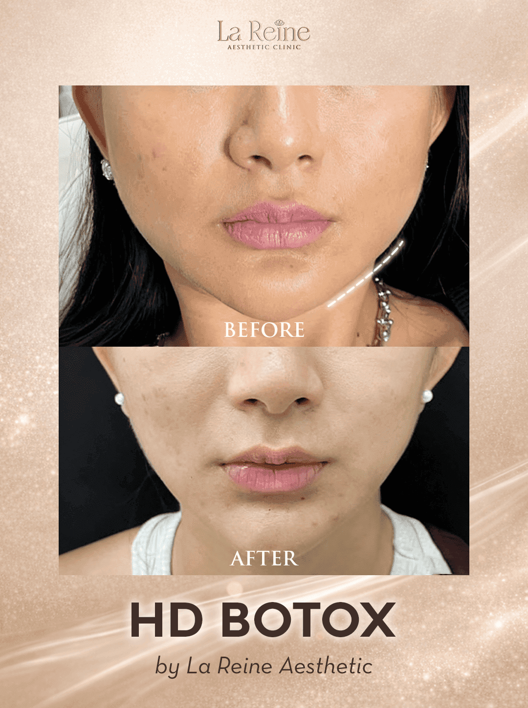 HD Botox Before After Case 3