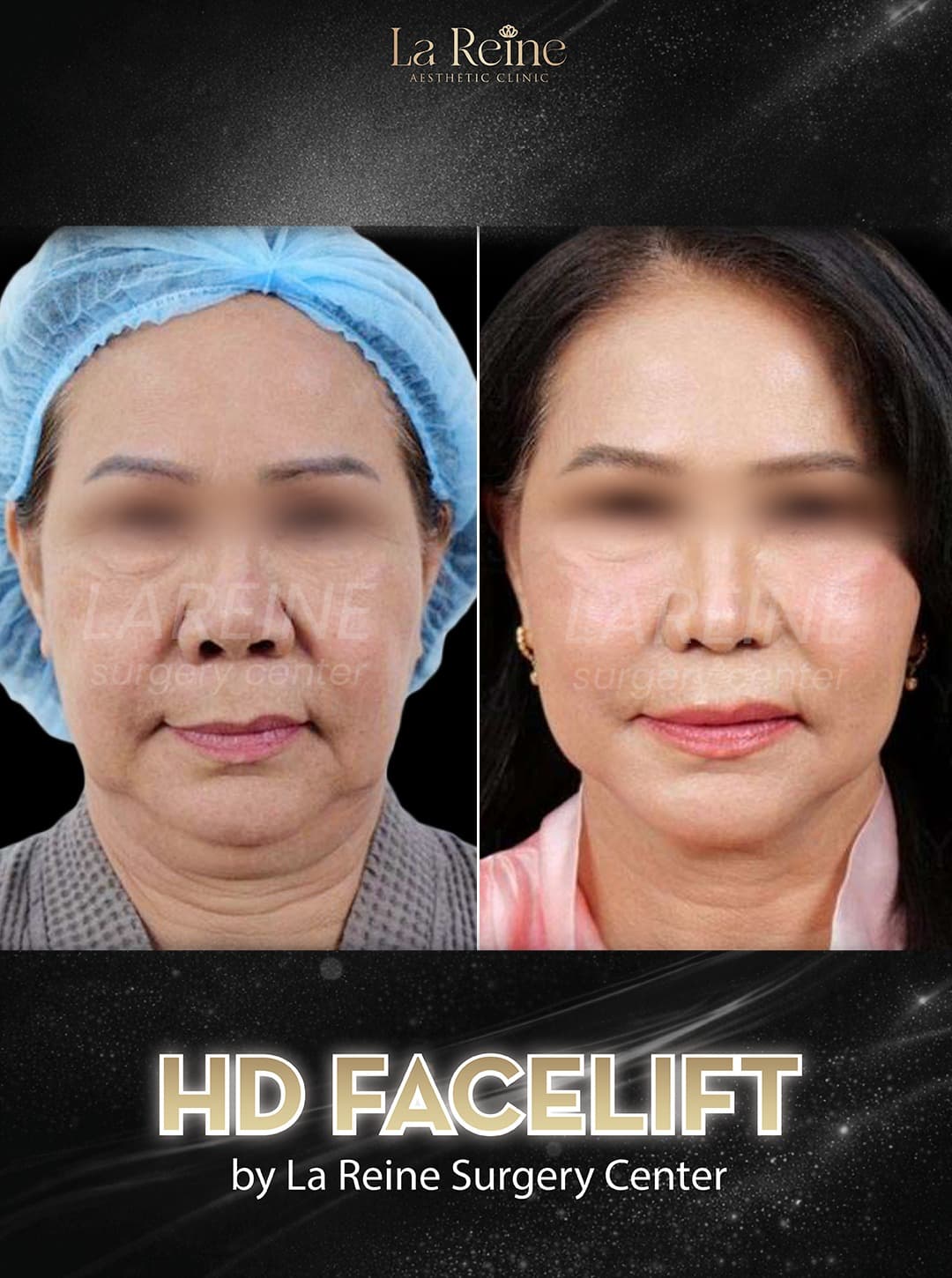 Facelift Before After Result 2