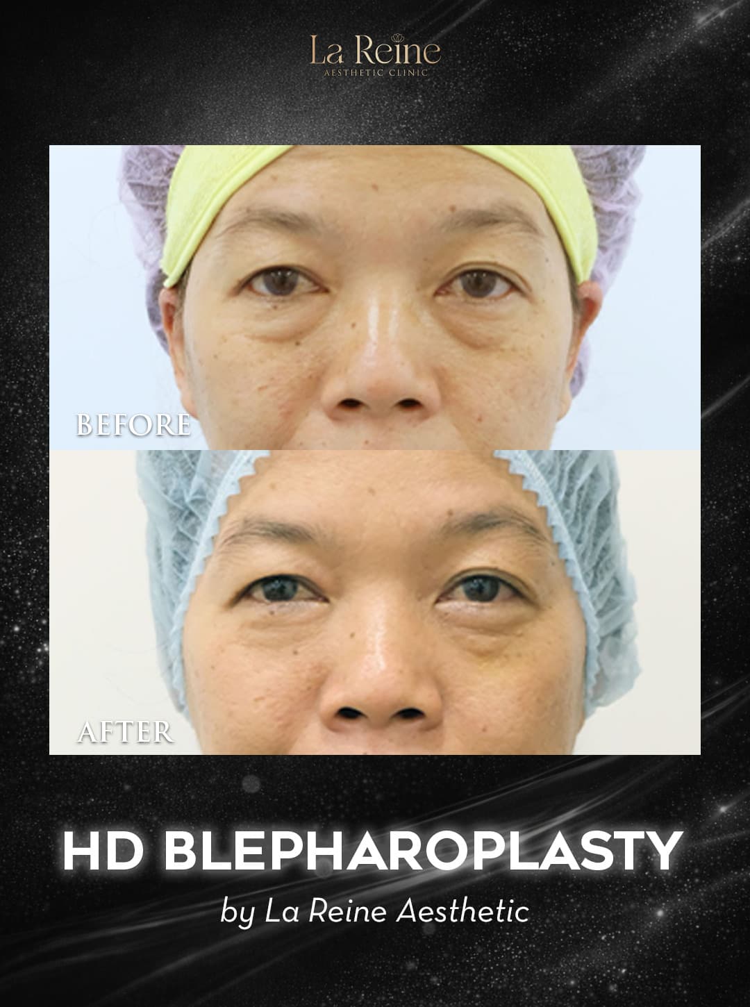 HD Blepharoplasty Before After Case 2