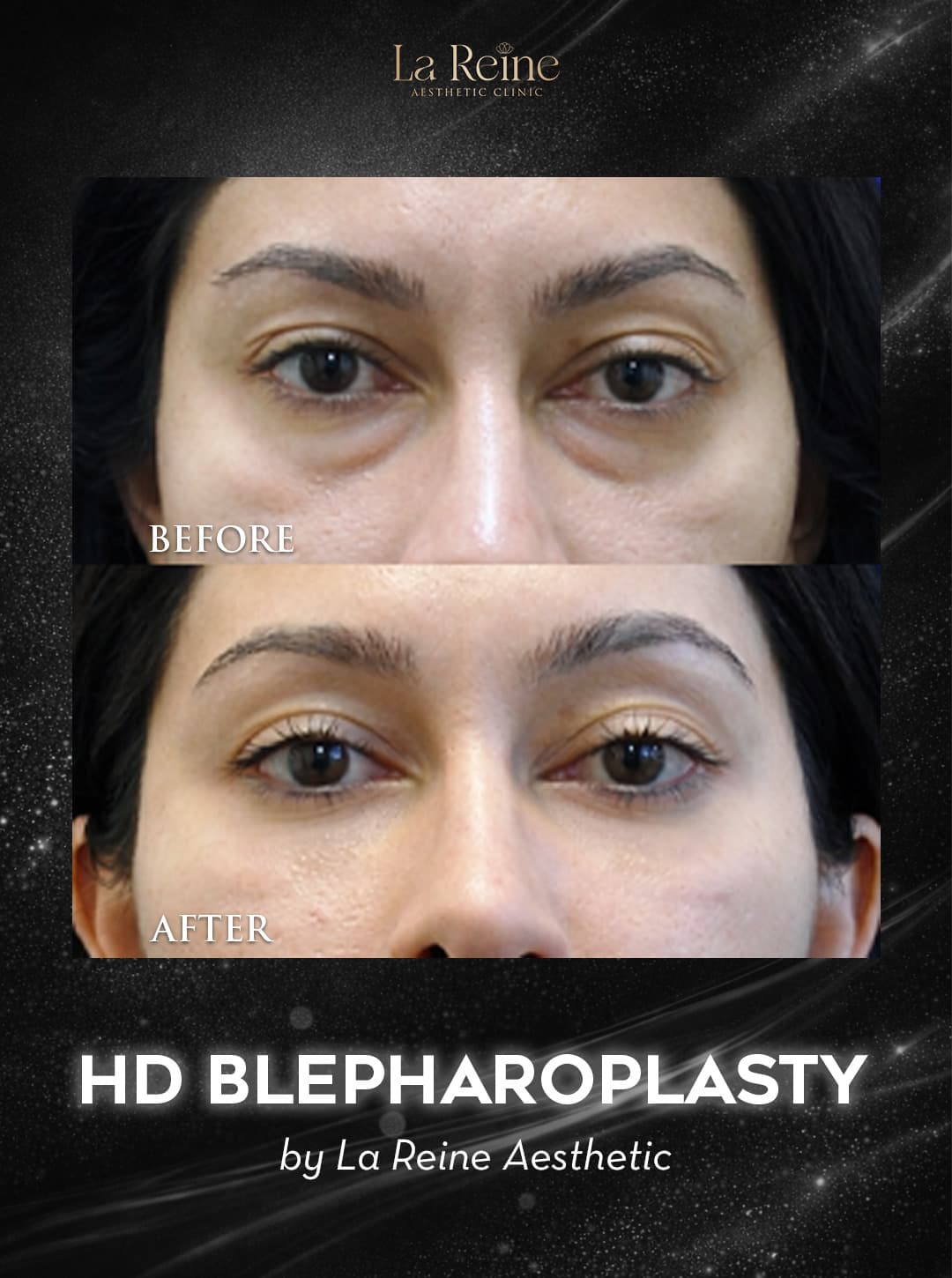 HD Blepharoplasty Before After Case 3