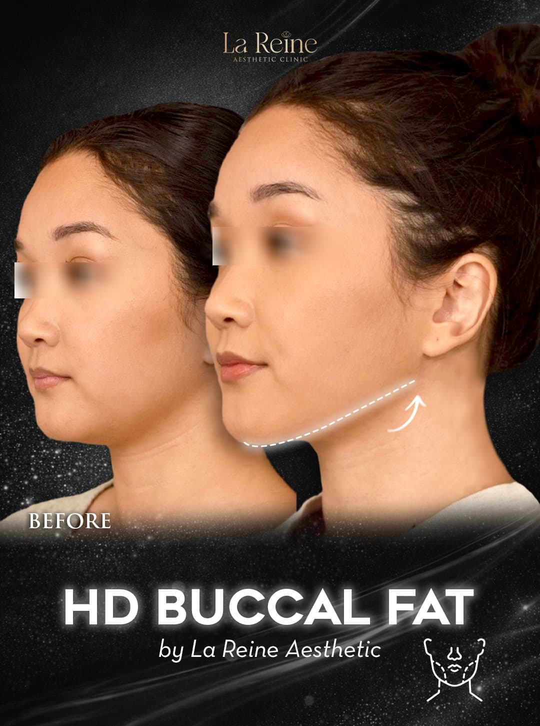 HD Buccal Fat Before After Case 1
