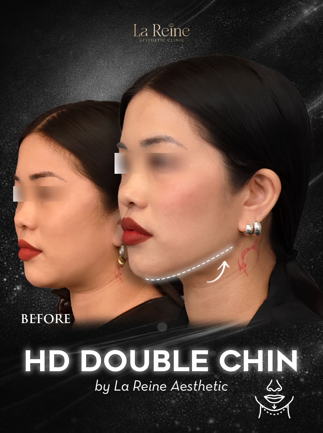 HD Double Chin Before After Case 1