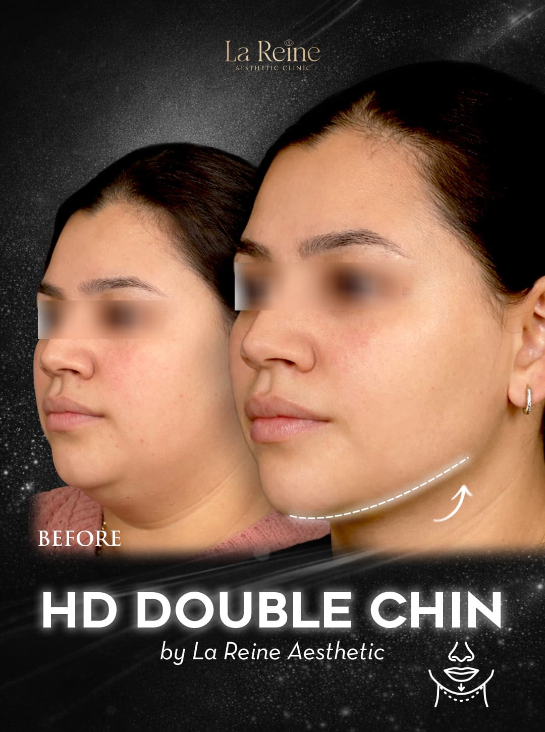 HD Double Chin Before After Case 2