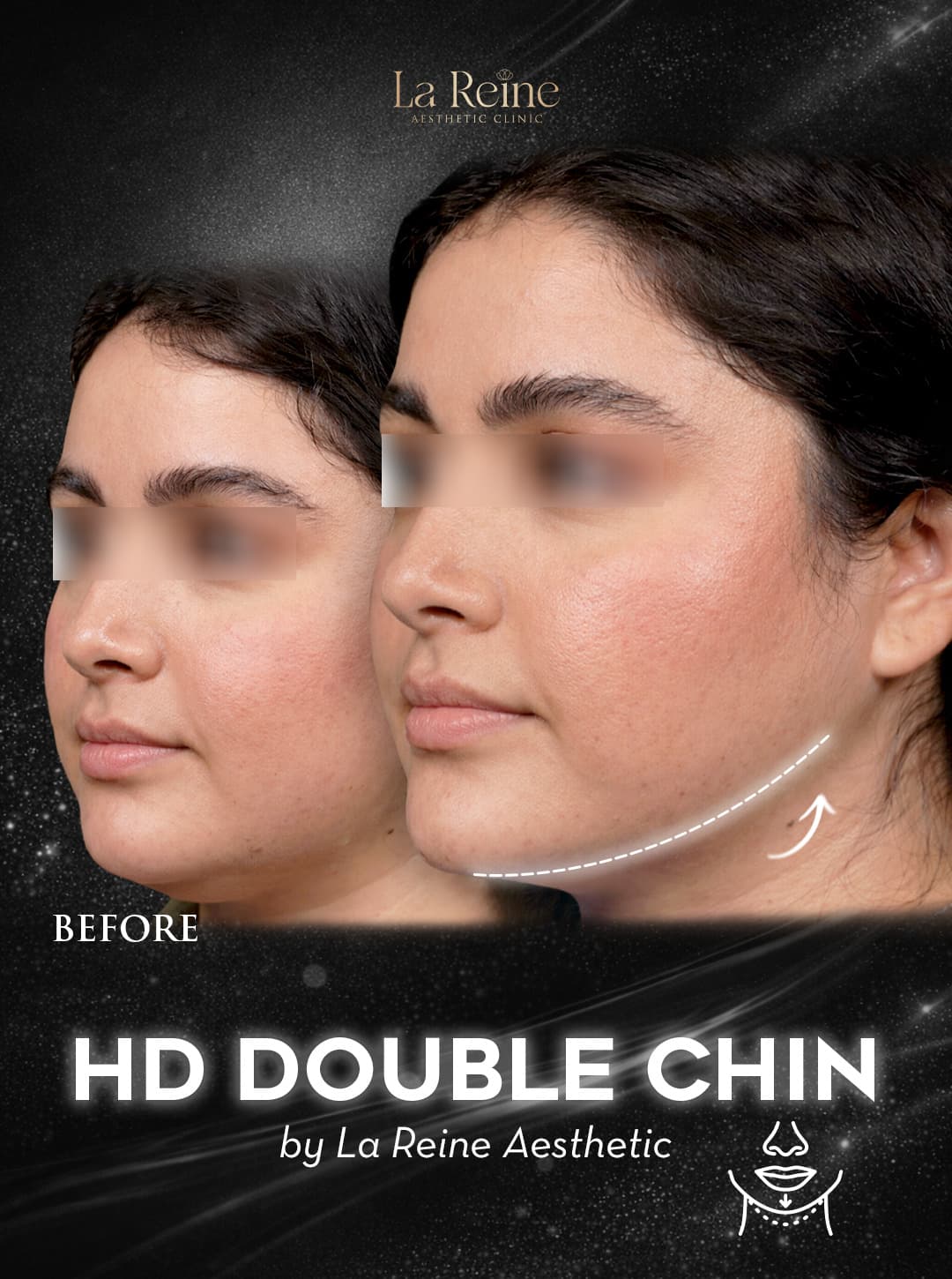 HD Double Chin Before After Case 3