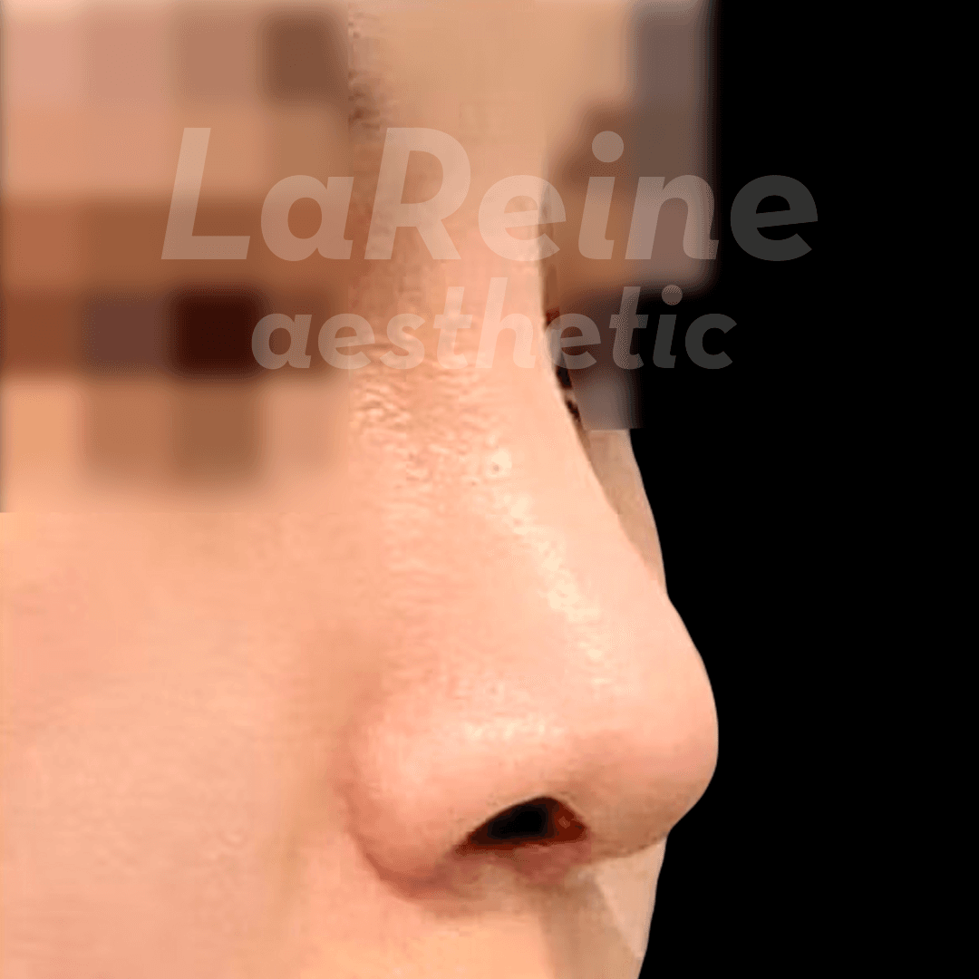 Rhinoplasty After Case 1