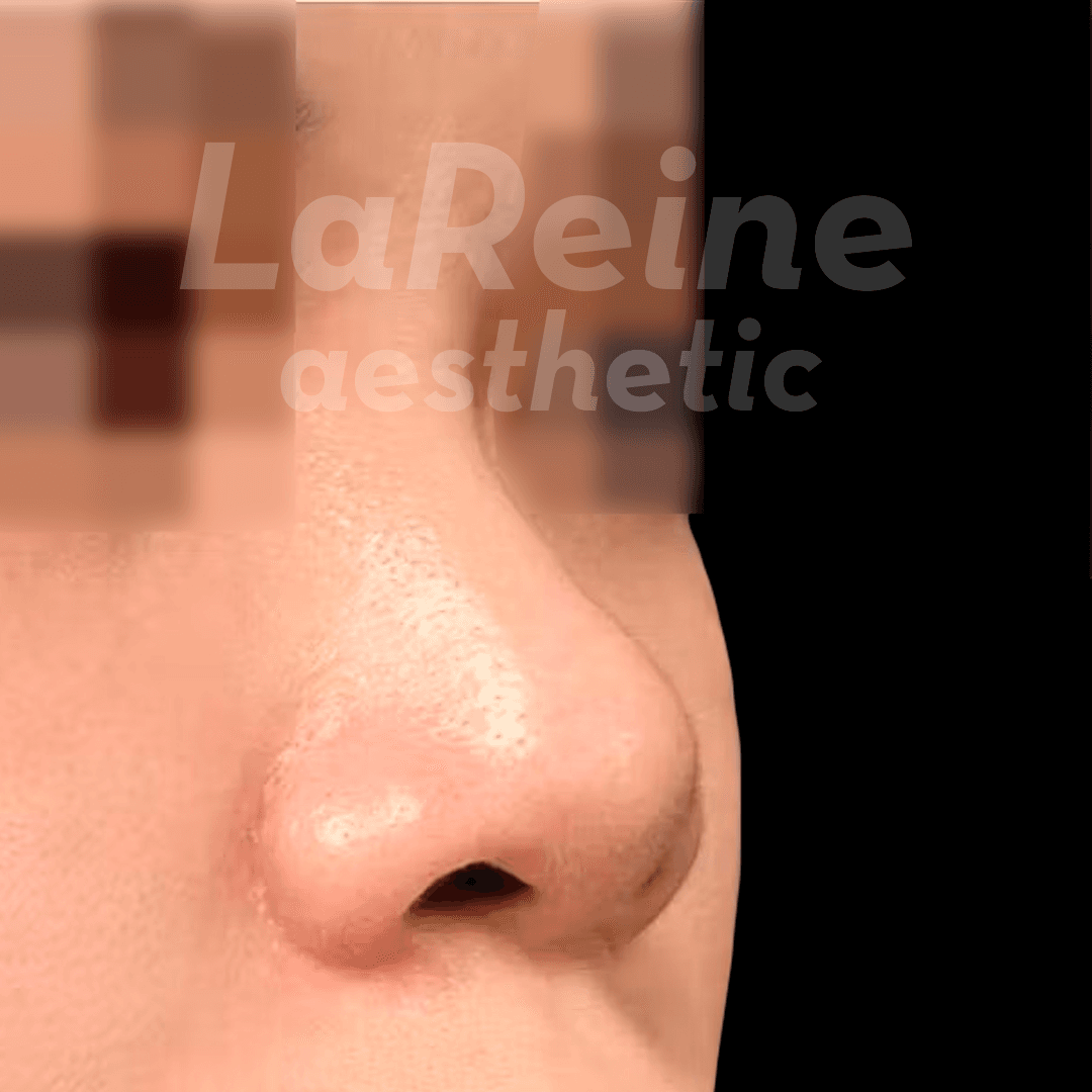 Rhinoplasty Before Case 1