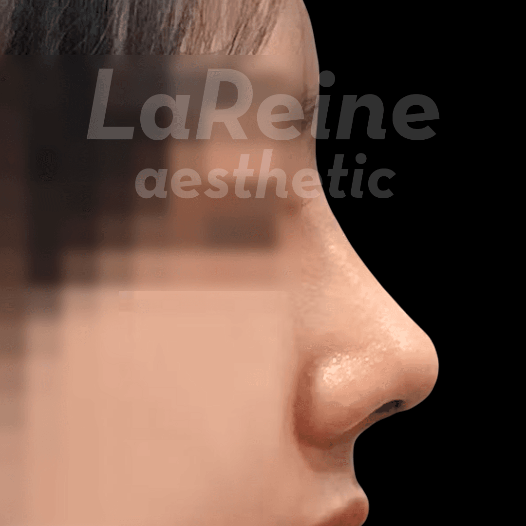 Rhinoplasty After Case 2