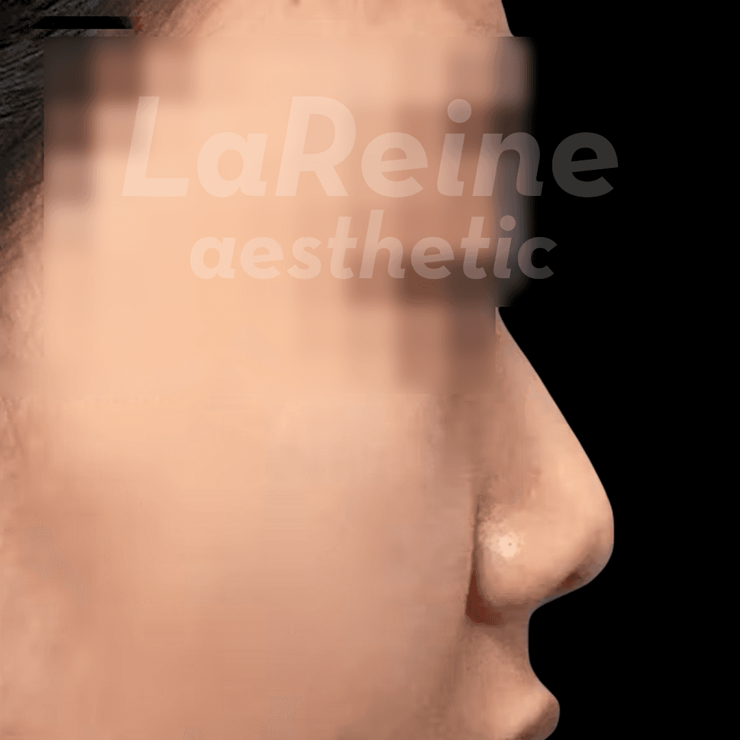 Rhinoplasty Before Case 2