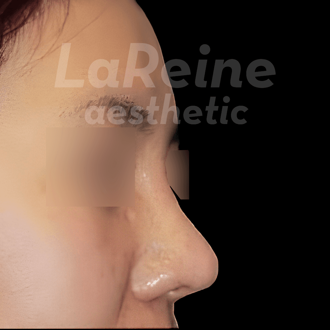 Rhinoplasty After Case 3