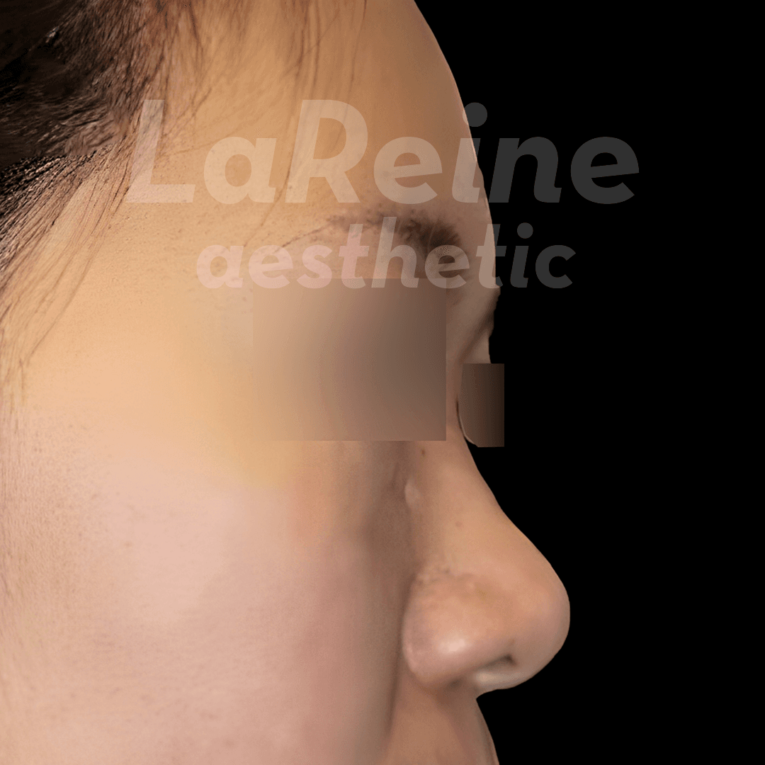 Rhinoplasty Before Case 3