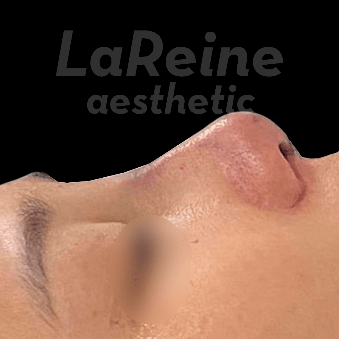 Rhinoplasty After Case 4