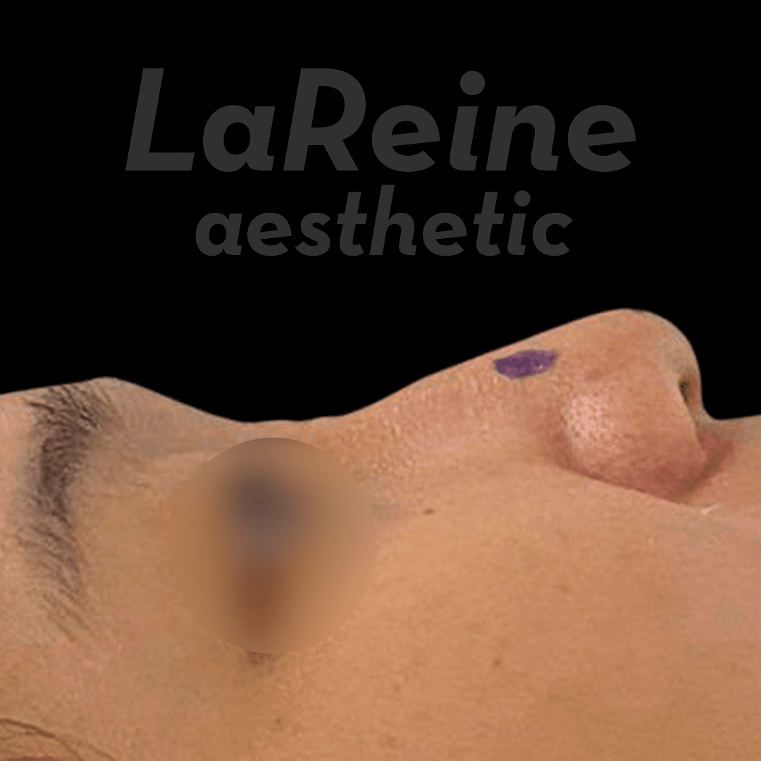 Rhinoplasty Before Case 4