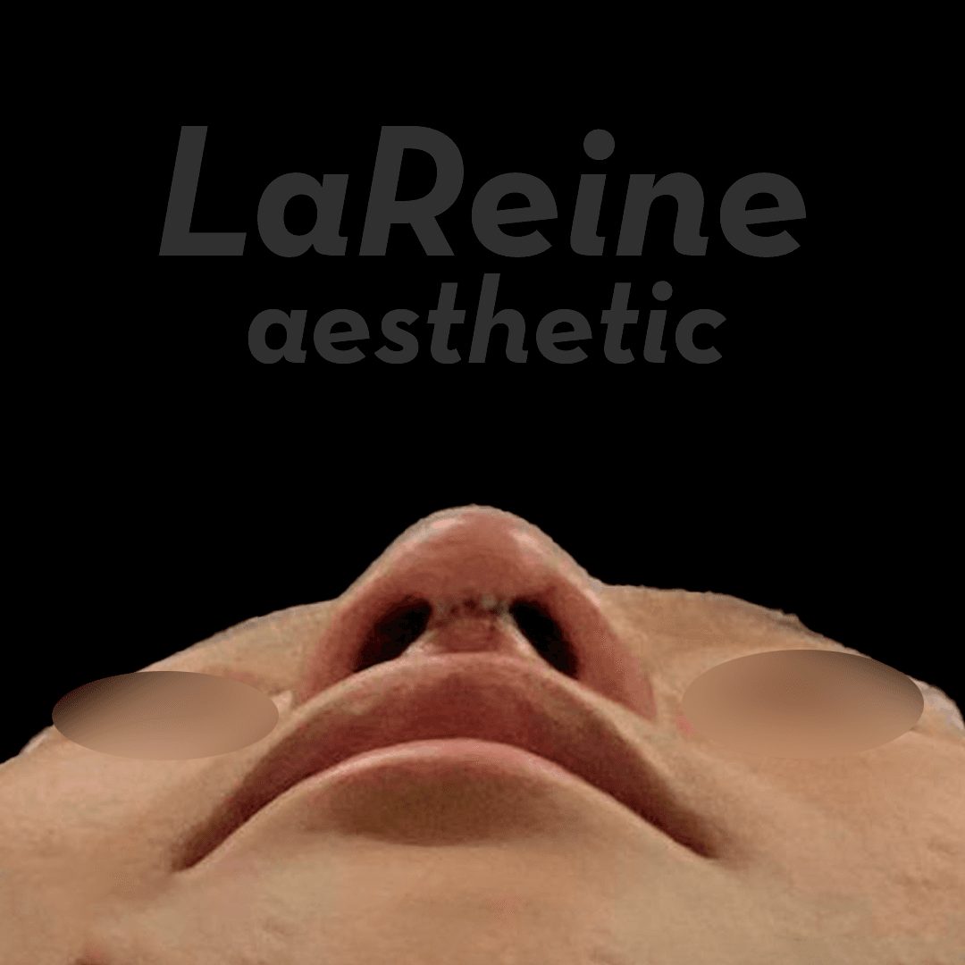 Rhinoplasty After Case 5