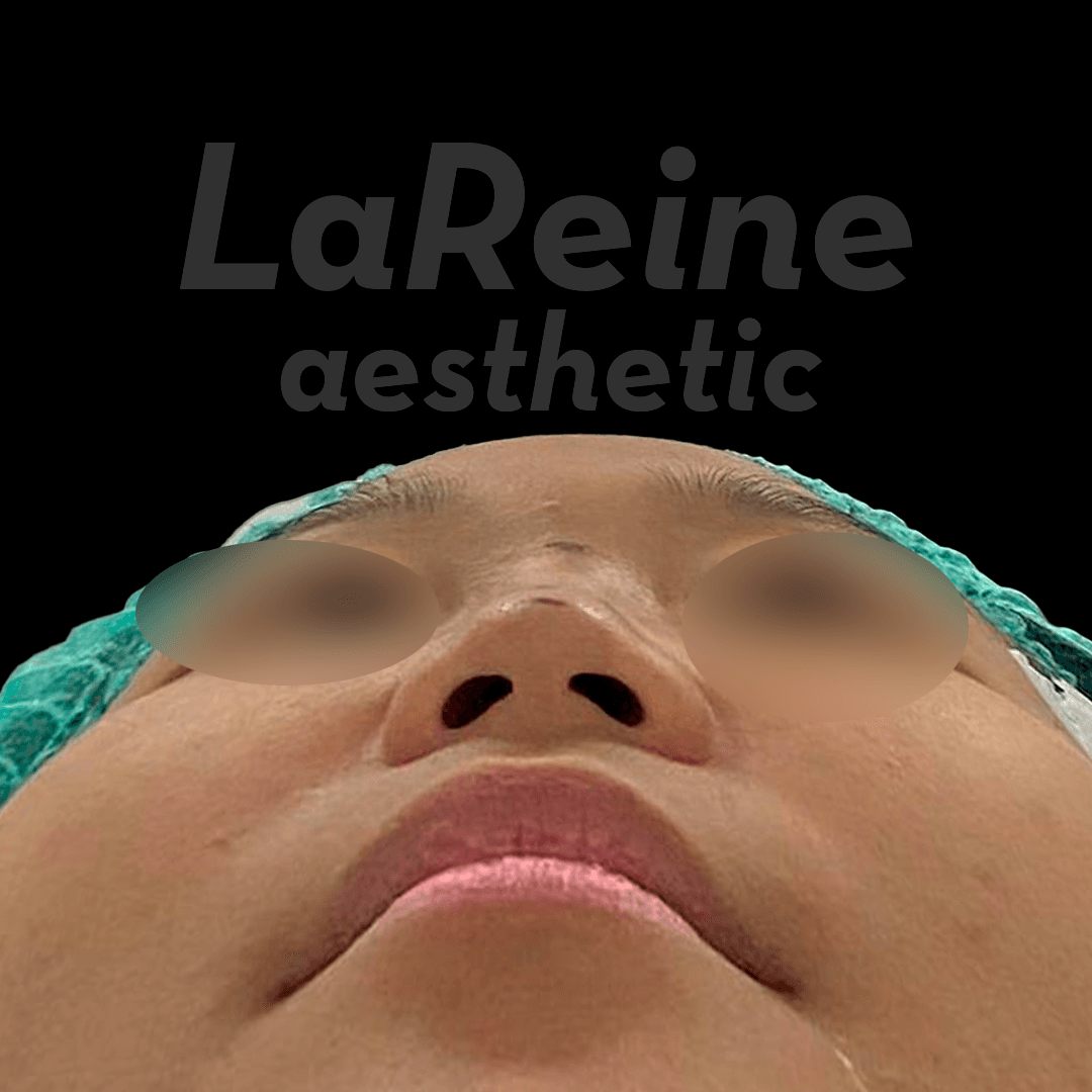 Rhinoplasty Before Case 5