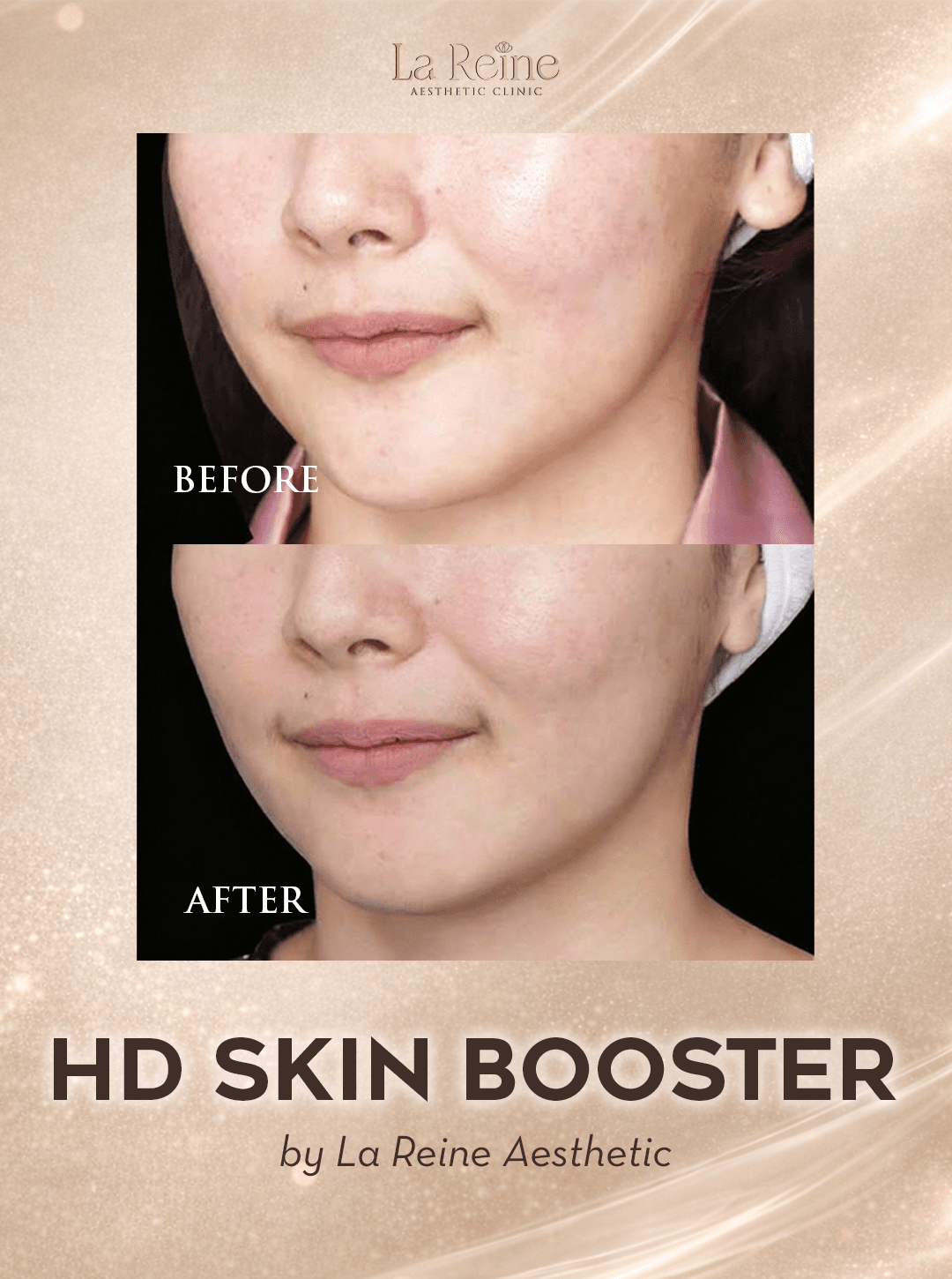 HD Skin Booster Before After Case 1