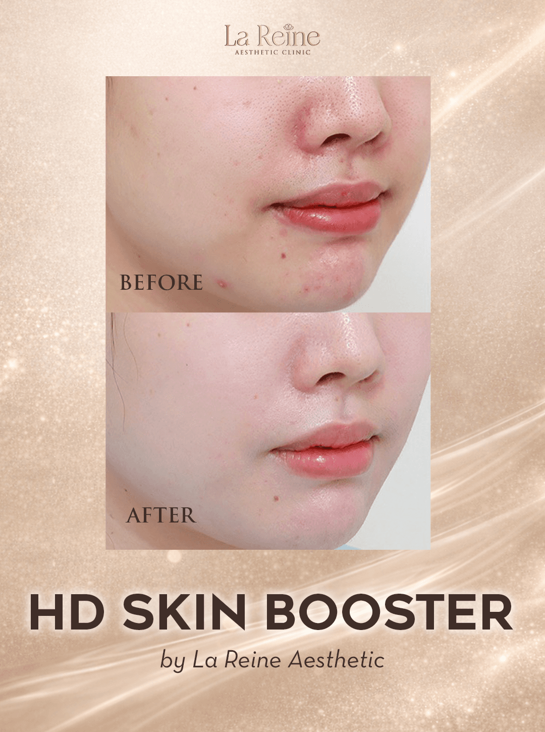 HD Skin Booster Before After Case 3
