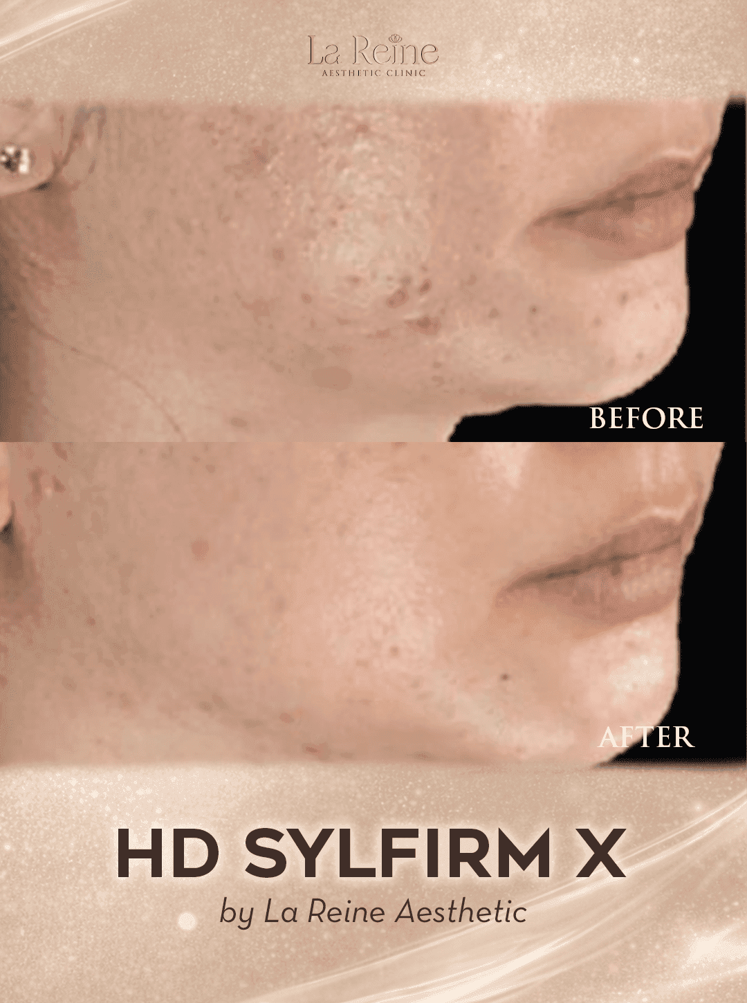 HD Sylfirm X Before After Case 1