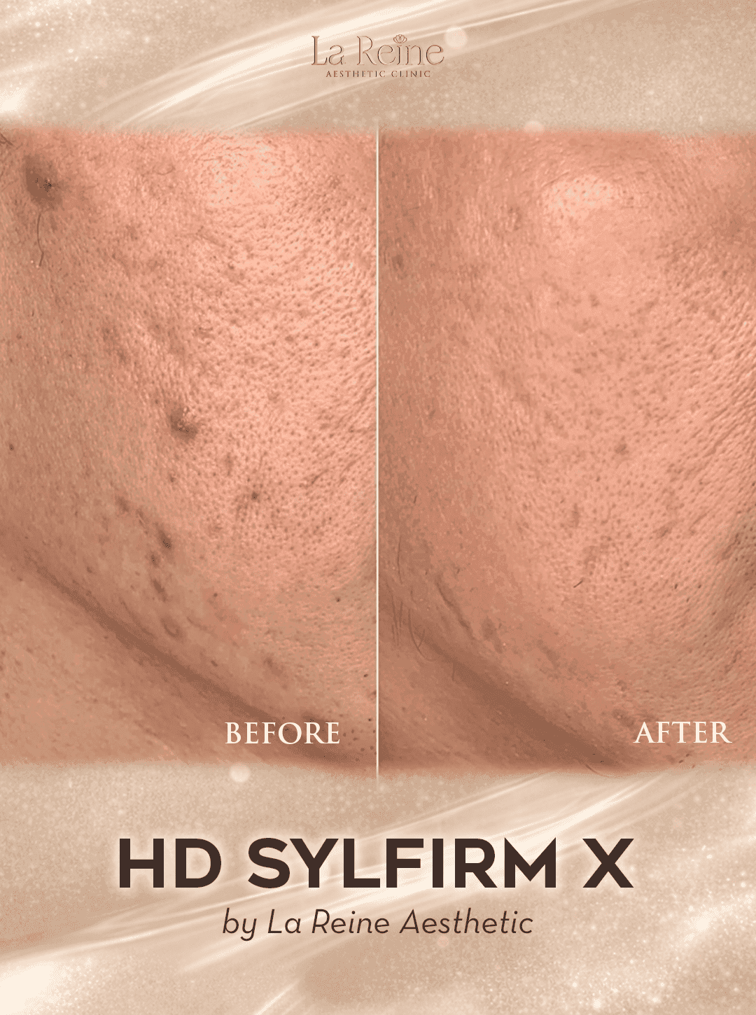 HD Sylfirm X Before After Case 2