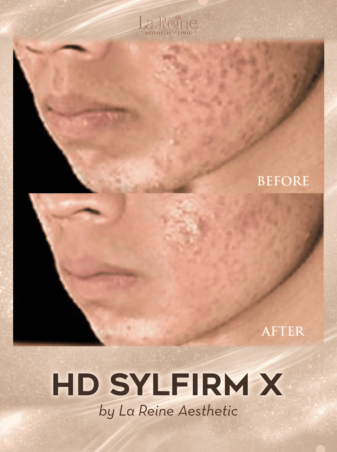 HD Sylfirm X Before After Case 3
