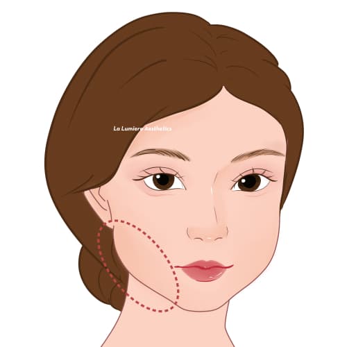 Prosedur Buccal Fat Langkah 01