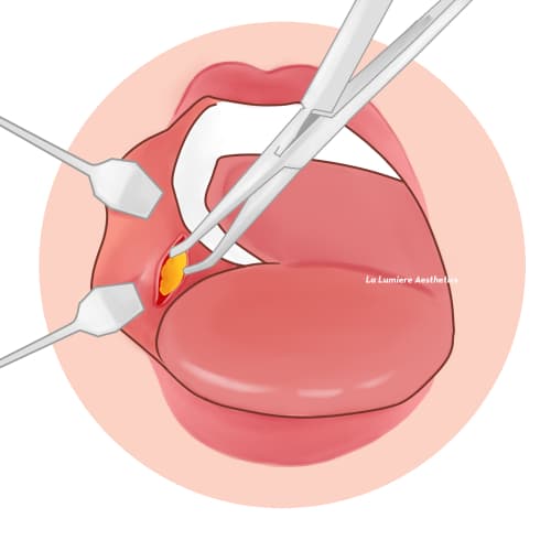 Prosedur Buccal Fat Langkah 03