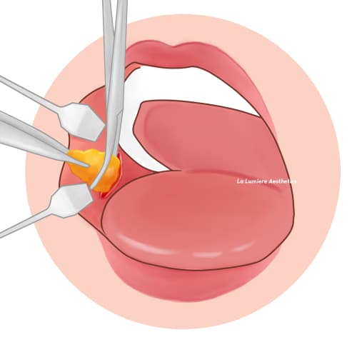 Prosedur Buccal Fat Langkah 04