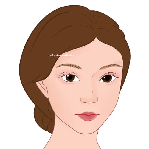 Prosedur Buccal Fat Langkah 05
