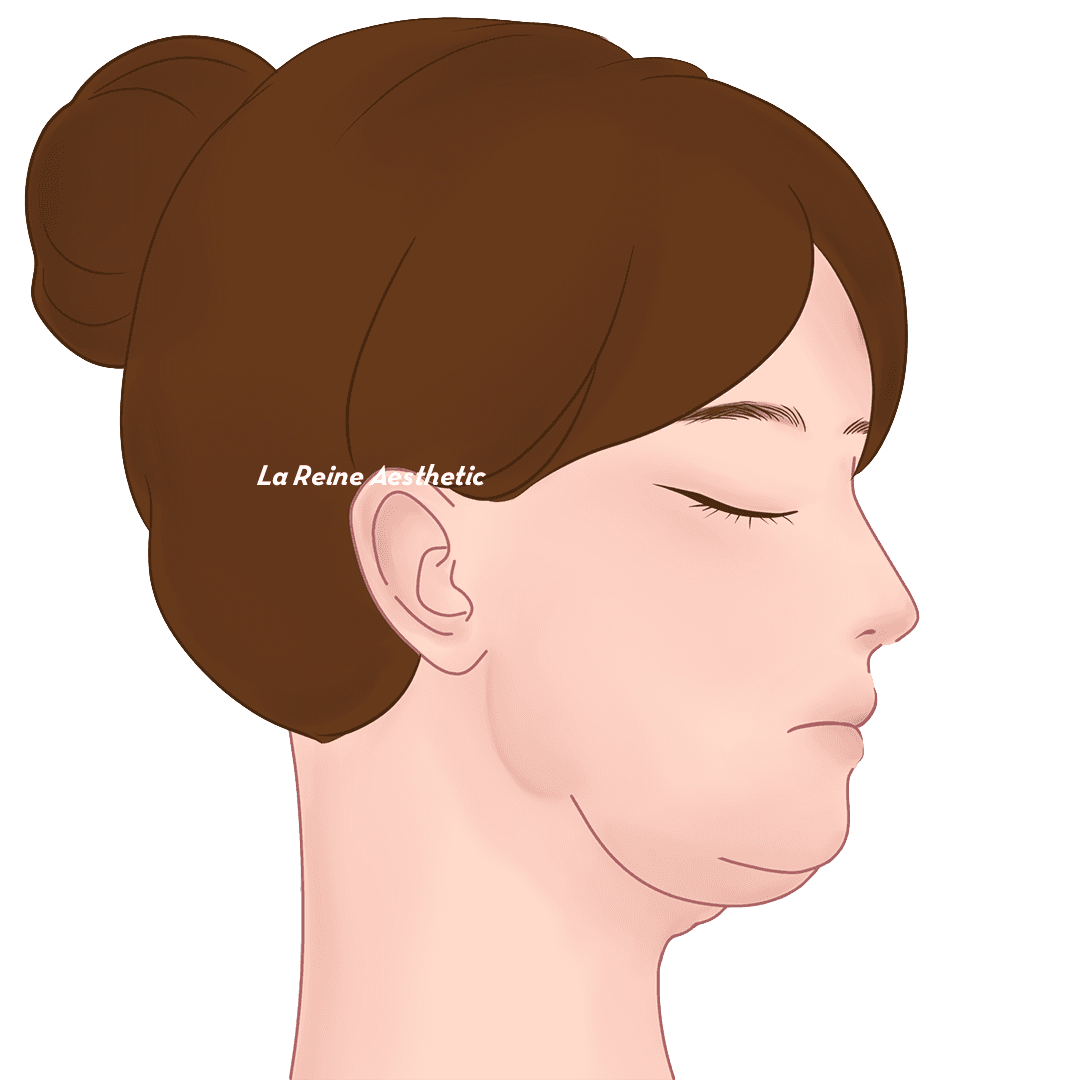 Prosedur Double Chin Langkah 01