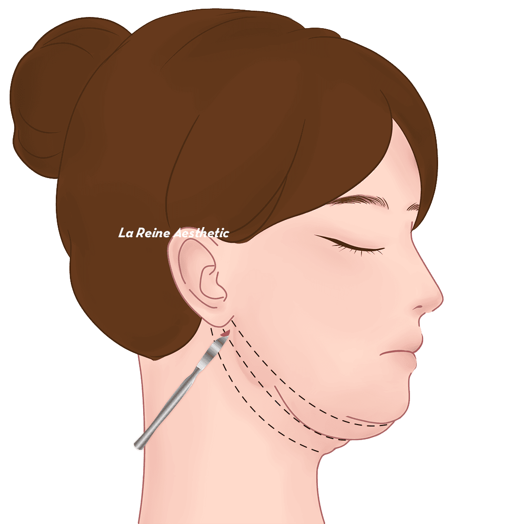 Prosedur Double Chin Langkah 03