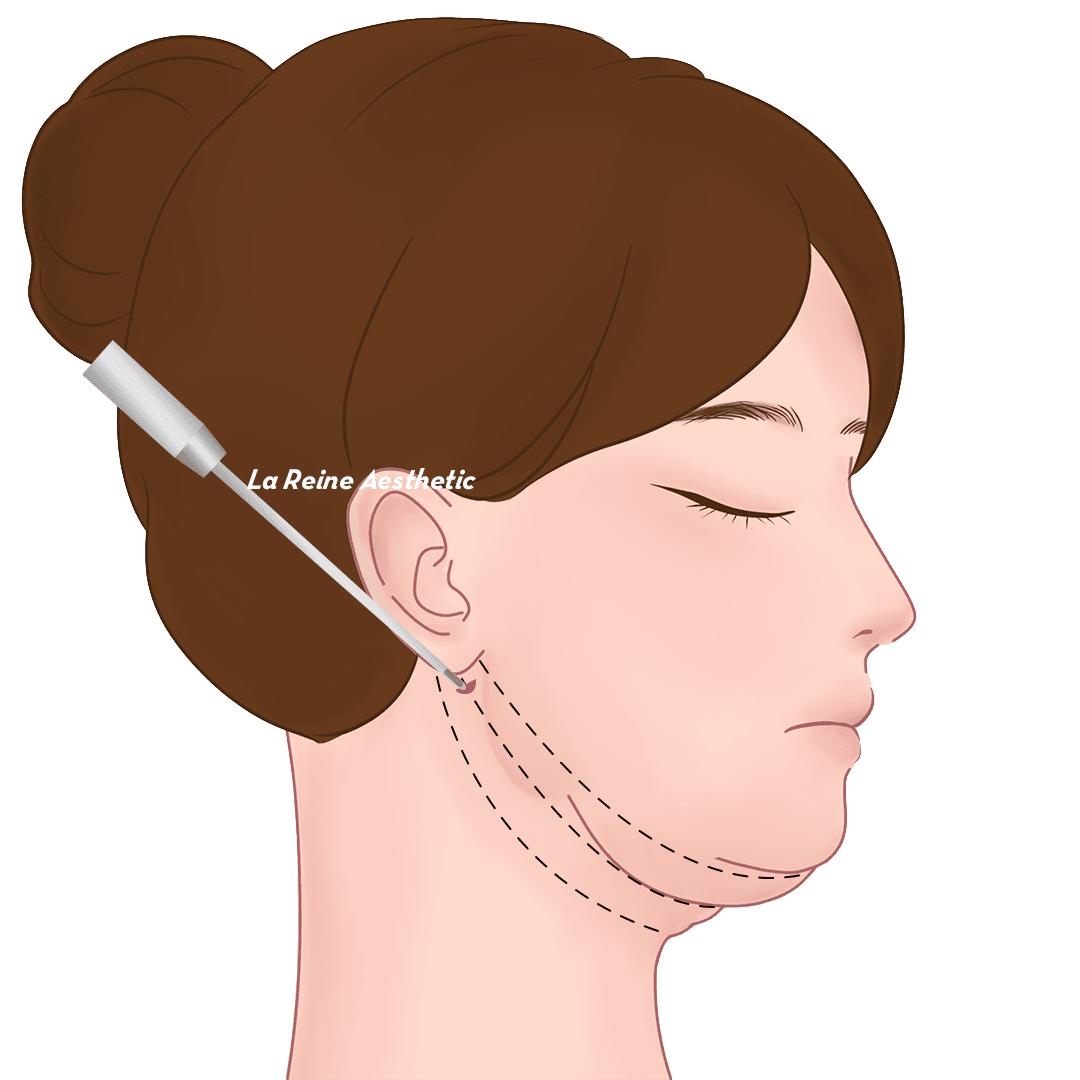 Prosedur Double Chin Langkah 04