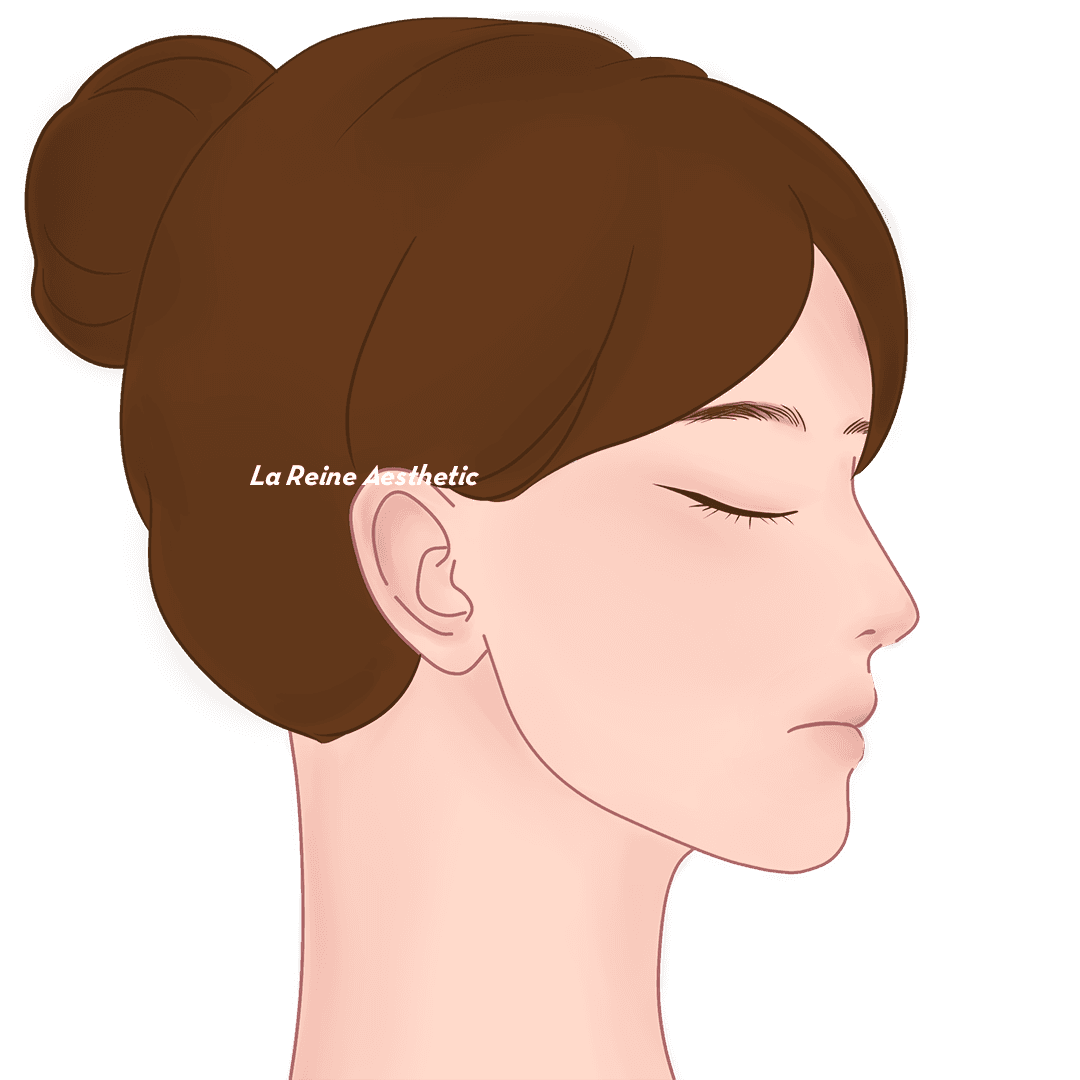 Prosedur Double Chin Langkah 05