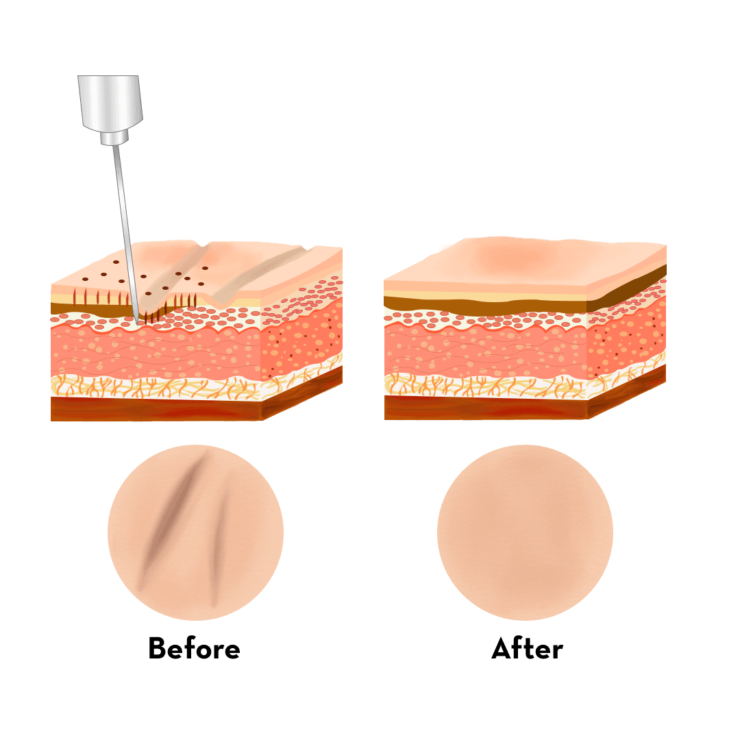 Ilustrasi Prosedur Botox Sebelum Sesudah