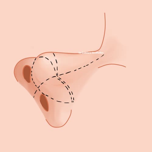 Prosedur Rhinoplasty Langkah 01