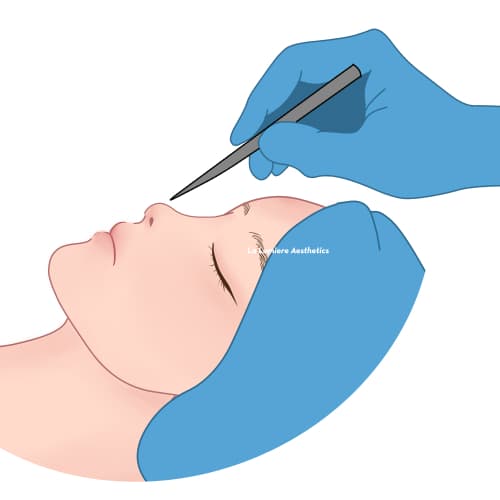 Prosedur Rhinoplasty Langkah 03