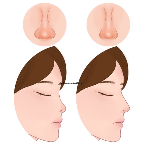 Prosedur Rhinoplasty Langkah 04