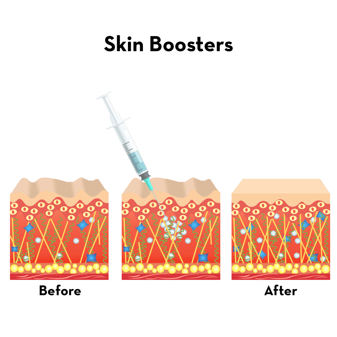 Skin Booster Layer Mechanism