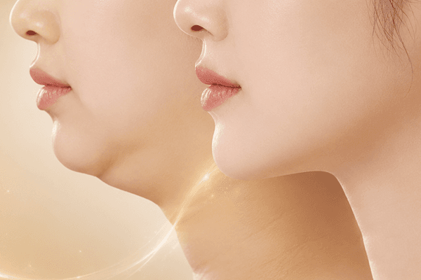 Buccal Fat Removal