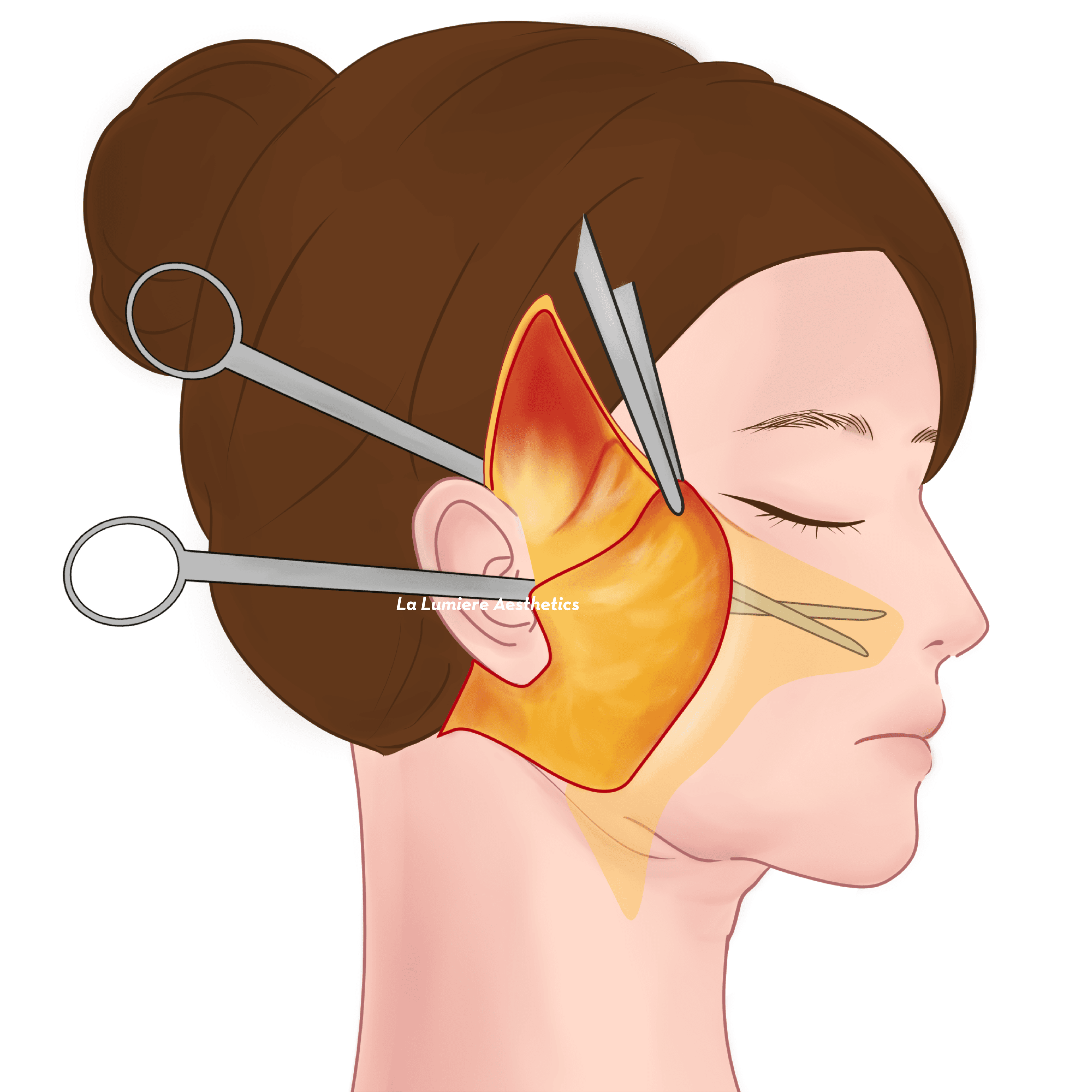 Prosedur Facelift Langkah 02