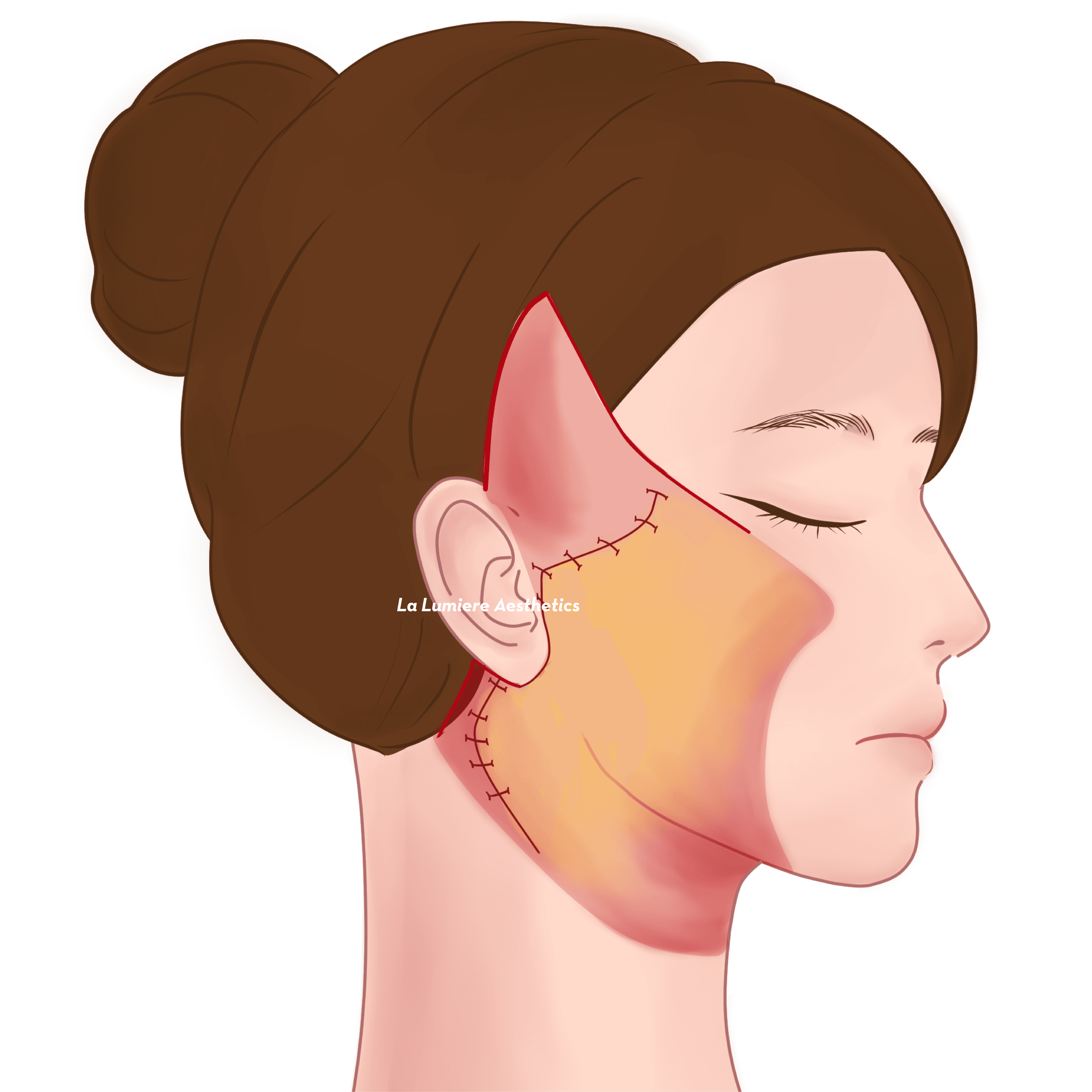Prosedur Facelift Langkah 04