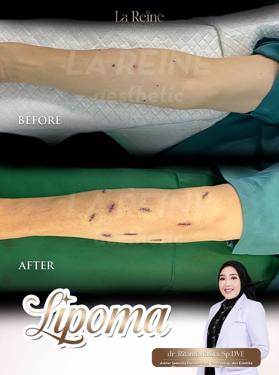 Lipoma Removal Before After Case 1