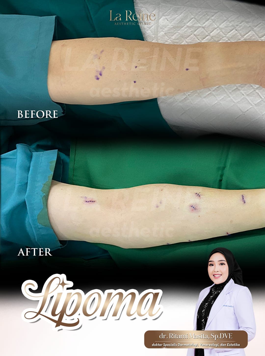 Lipoma Removal Before After Case 2